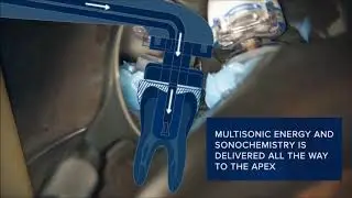 Forbes Endodontics GentleWave