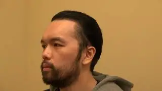 Hair transplant surgery to restore receding hairline results by Dr. Diep San Francisco, Ca