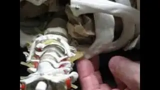 New Technique for Mobilizing the First Rib Hesch Method