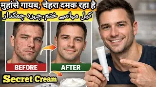 Secret Cream to Remove Acne Pimple Dark Spots | Get Glowing Skin 💯