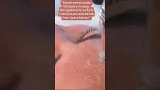 Microagulhamento com &aacute;cido hilarionico.