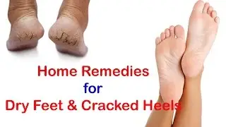 Remove Cracked Heels Fast || Home Remedies for Dry Feet & Cracked Heels Naturally