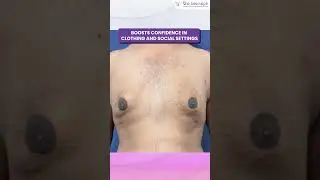 Gynecomastia Surgery Can Change Your Life, How? | The Aesculpir Clinic, Delhi