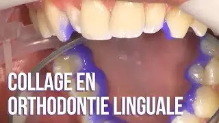 😛 Collage en orthodontie linguale