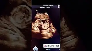 ERKEK BEBEGIMIZ.  CİNSİYET TESPİTİ.  15. HAFTA GEBELIK.  DR MEHMET BOZ 2023