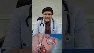 पेसमेकर लगाने के बाद दुबारा कब बदलना पड़ता है ? पेसमेकर कितने समय तक चलता है?replacement of pacemaker