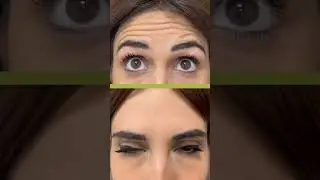 Botox prima e dopo