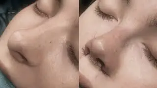 (EXP) bulbous nose tip reduction.