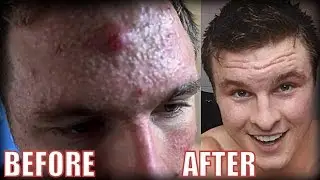 EPIC BODYBUILDER ACNE TRANSFORMATION!! ft. HumerusFitness