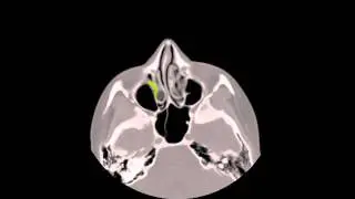 Enhanced Axial CT Scan of a right antrochoanal polyp