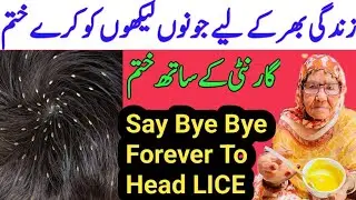 How to Get Rid Of Lice | Say Bye bye Forever Head lice | juon aur Likhon ko Khatam Karne ka Tarika
