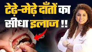 Braces on Teeth: फायदे, नुकसान और पूरी प्रक्रिया! Everything You Need to Know About Braces on Teeth