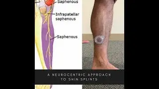 Shin Splints -- Common Reasons Why -- Uncommon Treatment Options