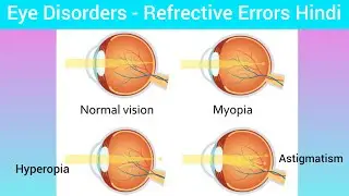 Refractive Errors of Eye in Hindi | Myopia, Hyperopia, Presbiopia |  Nursing MSN - 2 Eye Disorders