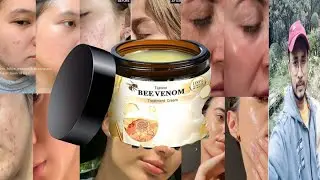 Bee Venom Treatment Cream | Honest Review