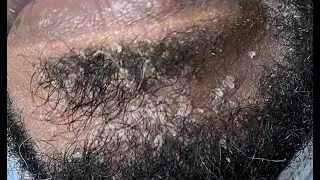Scratching BEARD FLAKES #psoriasisscalpremoval  #dandruffproblems  #dandruffscratching
