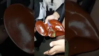 BARE AREAS OF LIVER