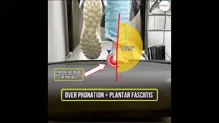 Sketchers on Treadmill: How Overpronation Causes Plantar Fasciitis | Ergonx | Learn the Link