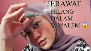 JERAWAT HILANG HANYA SEMALAM! | MASKER SPRILUNA