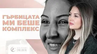 Три годишния резултат след риноплатика на Моника Симеонова при Др. Мухамет Дилбер