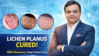 Lichen planus treatment success story of a patient 