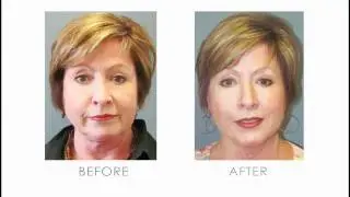 LiteLift&trade; Commercial - A Modified Facelift - Patty 2011