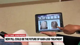 New pill could be the future of hair-loss treatment