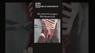 Rib Removal Surgery Explained | Rib Resection by Dr. of Physiotherapy 🥼🌟 #ribcartilage