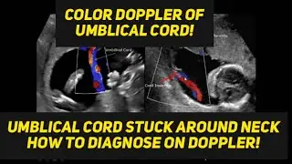 Umlical cord around neck | ultrasound diagnosis