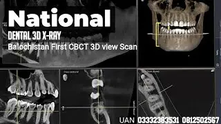 CBCT report maxillary L implants mapping By National Dental X-ray 