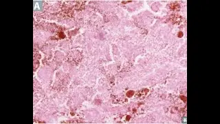 Coagulative necrosis
