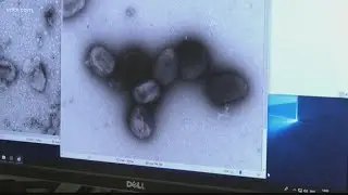 US now has more monkeypox cases than any other country in the world