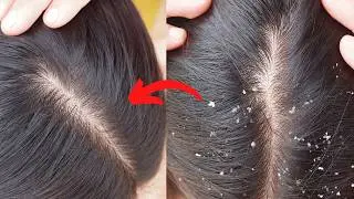 🔥#1 HOW TO TREAT DANDRUFF AT HOME ||| How to get rid of Dandruff |||Dandruff  Home Remedies!!!