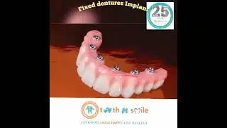 Fixed Dentures Implant. www.toothnsmile.com