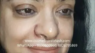 Rhinoplasty Alarplasty Nose Tip-plasty Before After Result Cost, India,  Delhi