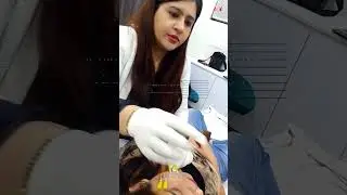Treating open pores and post acne marks with Dermal Threads