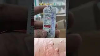 livocetrizne tablet | skin allergy #medical #skincare #livocetrizine #trending