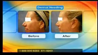 Dermal Needling Before and After