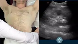 Как сканировать почки с помощью беспроводного ультразвука