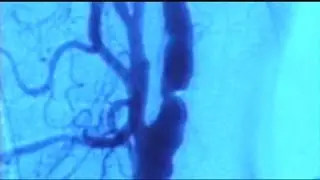 Stroke symptoms to be aware of