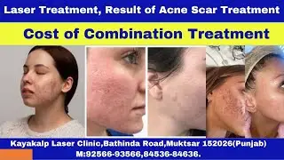 Laser Treatment, Result of Acne Scar Treatment | Cost of Combination Treatment