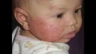 The Aron Regimen: Long-term Atopic Eczema Treatment