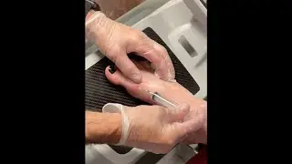 Stem Cell Injection for Hallux Varus Foot Condition