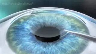 How does VisuMax works - eye surgery
