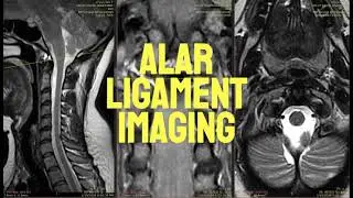 Alar Ligament Imaging for CCI