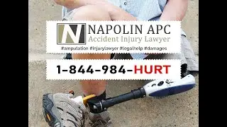 Napolin Amputation Injury Lawyer | Life And Legal Action After An Amputation Injury | Riverside