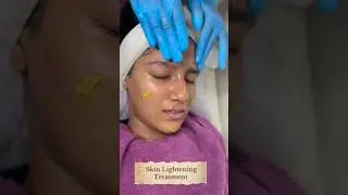Yellow Peel Skin Lightening peel.Skin Smile Clinic Bhopal ☎️ 9691918200#skincare #bhopal