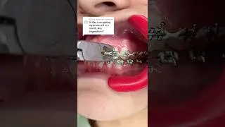 Tips you'll WANT to know if you're Getting your Braces Off