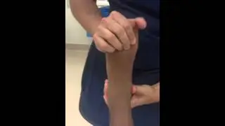 Pre and Postop Pediatric Flatfoot with Gastroc Equinus and Midtarsal Instability SFISM