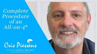 Dental Implants - Complete Procedure All-on-4 | Dr. Cris Piessens (ENG)